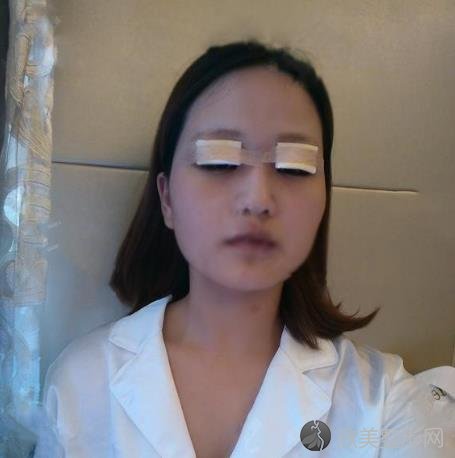 上海市闵行区中医院整形科怎么样？双眼皮案例+恢复效果图一览