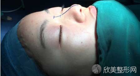 南京美贝尔整形科普：鹰钩鼻整形手术的准备工作和整形方法介绍