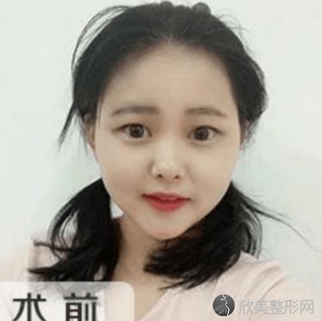 湛江中心人民医院整形科究竟好不好？-内附双眼皮恢复过程图一览