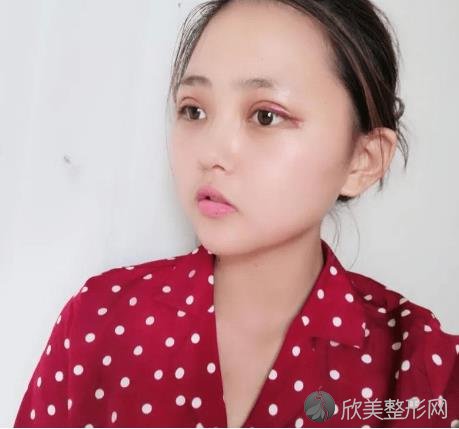 湛江中心人民医院整形科究竟好不好？-内附双眼皮恢复过程图一览