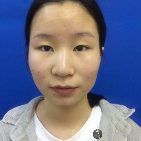 台州市立医院整形科双眼皮怎么样？附双眼皮手术恢复过程一览！