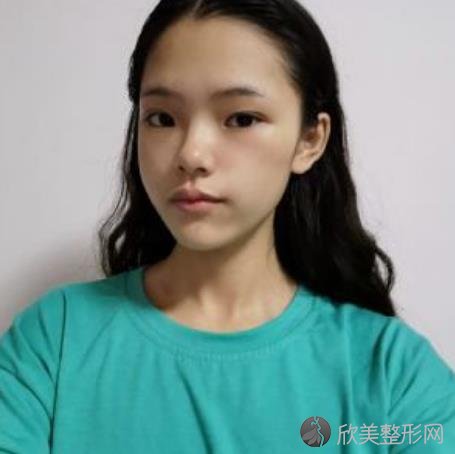 华西医院整形美容科技术究竟怎么样呢？对比面部拉皮提升案例恢复效果反馈