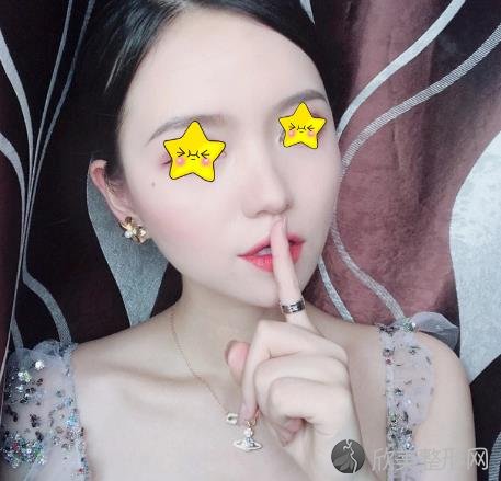 南京美莱赵其中鼻修复技术怎么样呢？来看看案例术后恢复照片就知道了