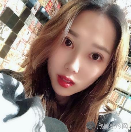 蚌埠市较好人民医院双眼皮怎么样？效果好不好？附加双眼皮案例分析