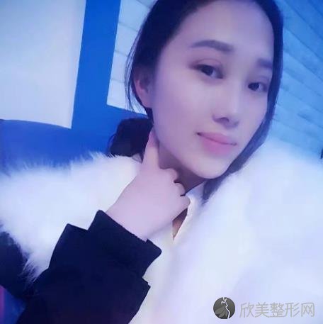 蚌埠市较好人民医院双眼皮怎么样？效果好不好？附加双眼皮案例分析