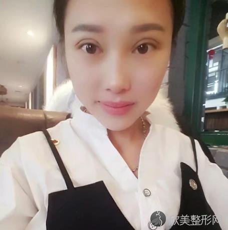 蚌埠市较好人民医院双眼皮怎么样？效果好不好？附加双眼皮案例分析