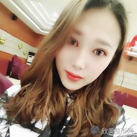 蚌埠市较好人民医院双眼皮怎么样？效果好不好？附加双眼皮案例分析