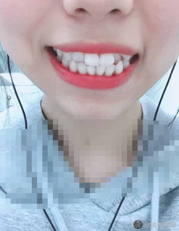 珠海拜博口腔医院做牙齿矫正之前