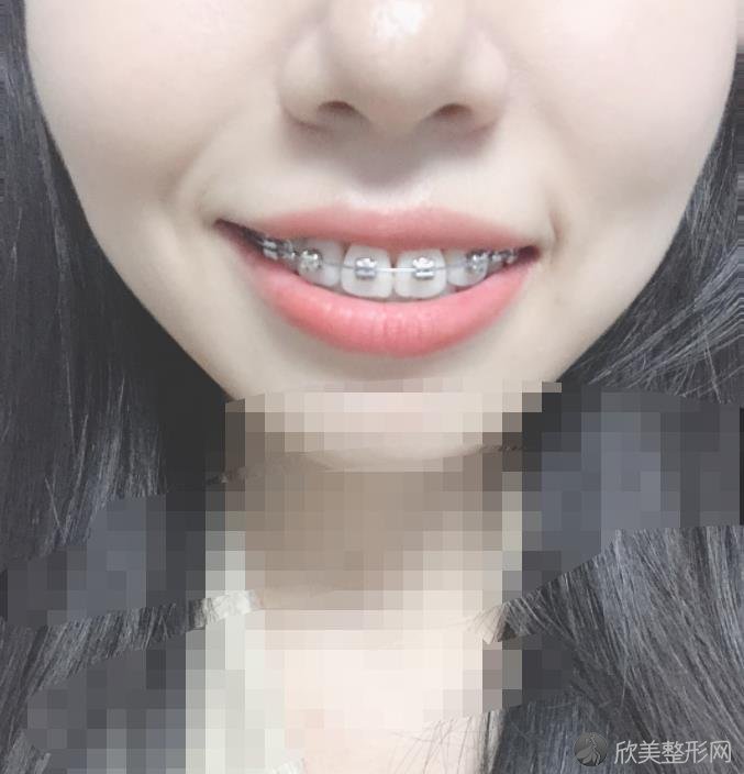 珠海拜博口腔医院做牙齿矫正之后