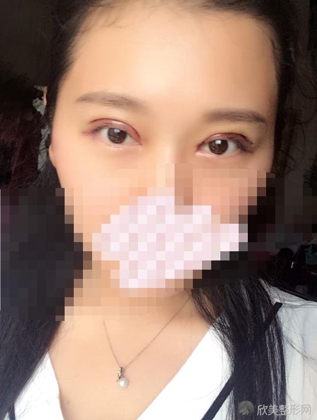 师丽丽医生双眼皮修复之后