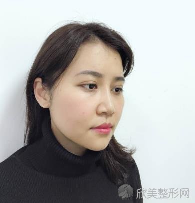 烟台鹏爱整形面部线雕效果好不好？内附案例对比