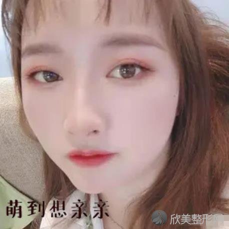 蚌埠市第二人民医院整形科做算个呼延丕效果好不好？内附双眼皮手术效果图一