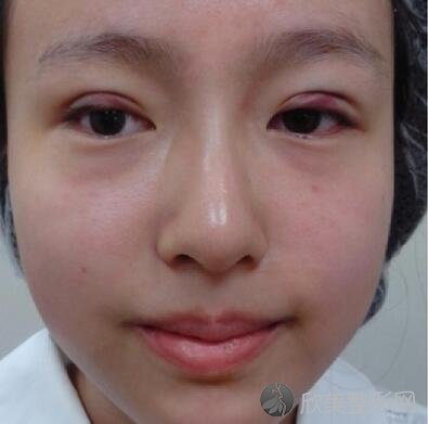 胡瑾医生做双眼皮怎么样？附双眼皮案例：我也有卡姿兰大眼睛辣！