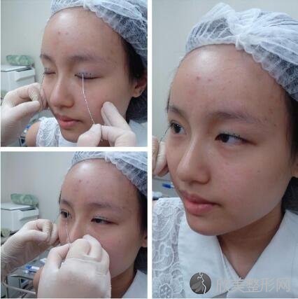 胡瑾医生做双眼皮怎么样？附双眼皮案例：我也有卡姿兰大眼睛辣！