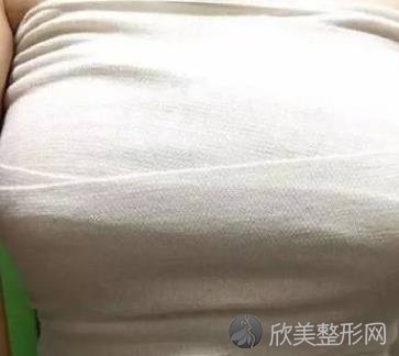上海九院曹卫刚抽脂隆胸怎么样？对比真实案例，简直天壤之别