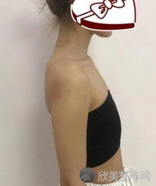 上海九院曹卫刚抽脂隆胸怎么样？对比真实案例，简直天壤之别
