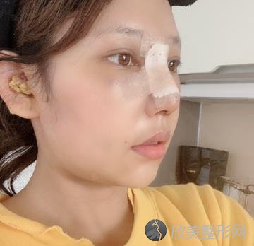 上海华美医院双眼皮做的怎么样？分享双眼皮+隆鼻手术案例