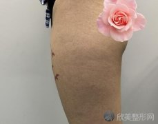 上海九院整形科做的全身吸脂手术，术后真的瘦了一大圈