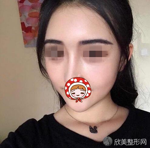 郑州集美刘德辉祛眼袋+自体脂肪填充案例 面部年轻一步逆袭