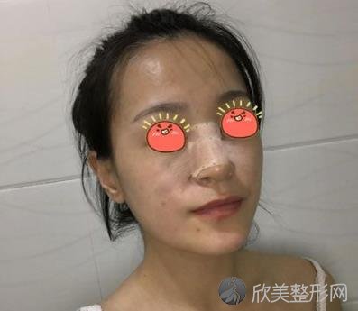 浙江省人民医院整形外科隆鼻子案例，效果恢复得很稳定