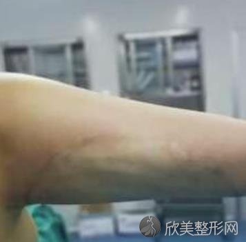 南京鼓楼医院美容科价项目目表，手臂吸脂案例图鉴！