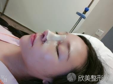 长沙美莱潘卫峰做假体隆鼻3个月恢复照在线实时分享