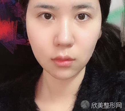 南京美莱整形医院垫下巴自然吗 亲测效果展示 前后对比 欣美整形