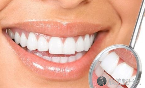 牙齿美白价格大概多少左右？受哪些因素影响？有什么优势？