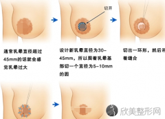 什么是乳晕缩小？做乳晕缩小手术需要多少钱？