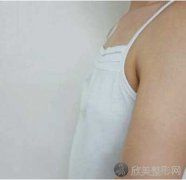 西安美莱王鹏做自体脂肪隆胸真人案例分享，附前后对比图