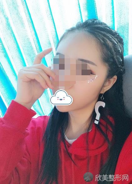 舒百颜医疗美容医院做面部填充之后