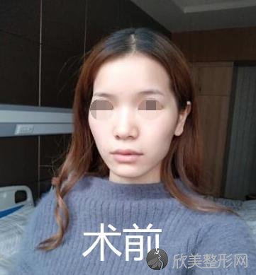 贵阳秀颜国际医疗做<a href='https://www.joshreso.com/mianbuzx/' target='_blank'><u>面部填充</u></a>之前