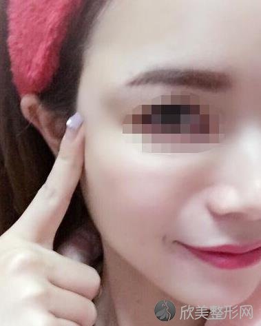 贵阳秀颜国际医疗做面部填充之后
