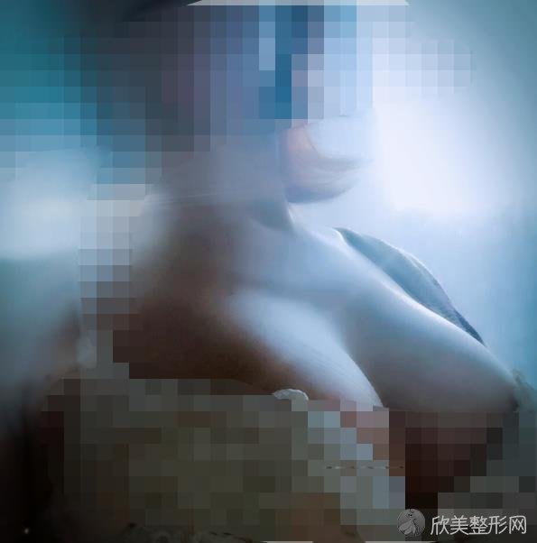 福州比华利美容医院做胸部整形之后