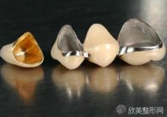 成都烤瓷牙价格影响因素有哪些？内附口腔医院牙齿美容的收费