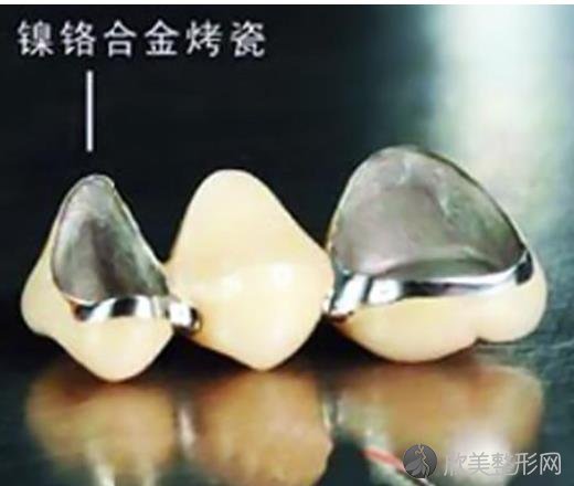 成都烤瓷牙价格影响因素有哪些？内附口腔医院牙齿美容的收费明细表