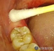 什么是智齿冠周炎？来看一下智齿冠周炎图片
