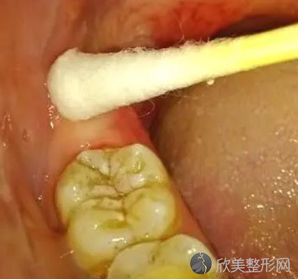 智齿冠周炎