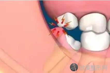 智齿冠周炎