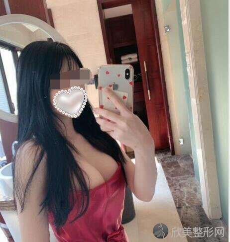 隆胸术后30天