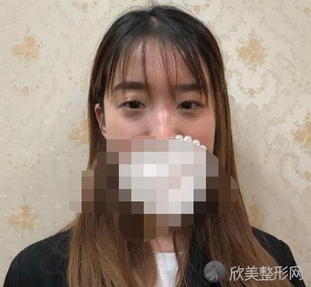 云南伍森林做双眼皮之前