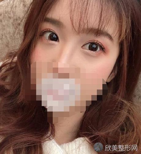 云南伍森林做双眼皮之后