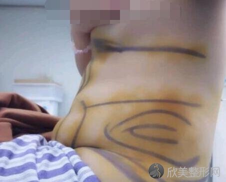 腰腹吸脂术前