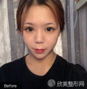 重庆王志军医生脂肪填充手术怎么样？内附真实案例+较新价格表！