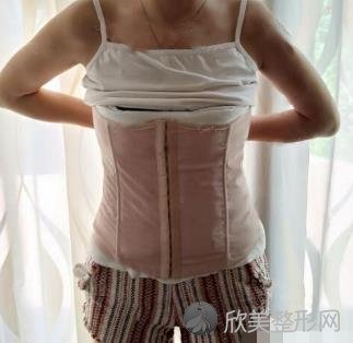 长沙爱思特整形医院吸脂手术怎么样？内附真实案例不要错过哦~