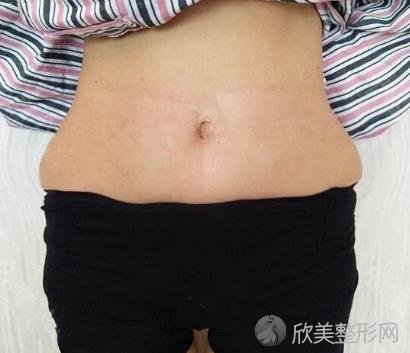 长沙爱思特整形医院吸脂手术怎么样？内附真实案例不要错过哦~