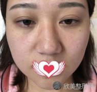 上海九院陈付国医生脂肪填充手术做的效果如何？一起看看叭！