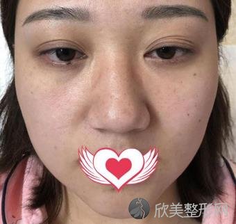 上海九院陈付国医生脂肪填充手术做的效果如何？一起看看叭！