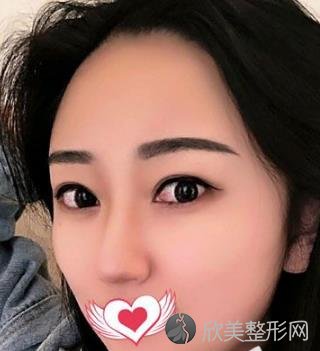 上海九院陈付国医生脂肪填充手术做的效果如何？一起看看叭！