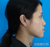 山西医科大学医院整形美容科自体脂肪面部填充手术怎么样？内附真实案例_价